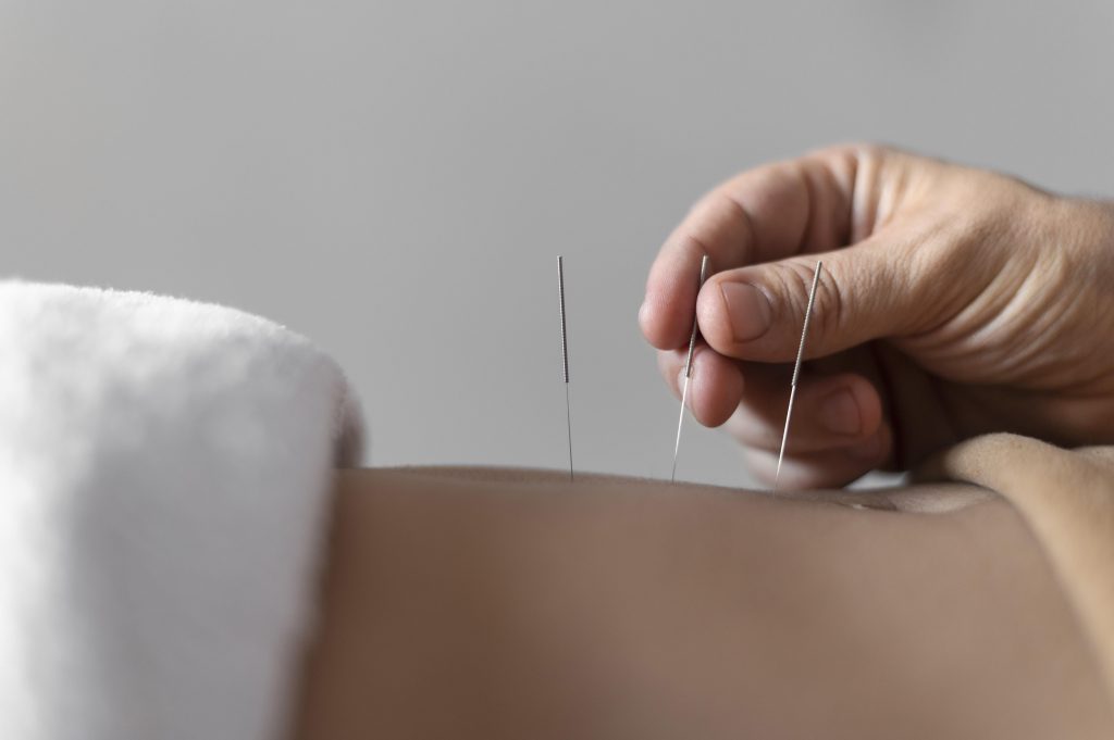 Can acupuncture really balance your QI and improve your health?